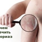 чем лечить псориаз